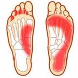 Athlete's Foot - Herbal Remedies