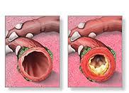 Bronchitis Herbal Remedies