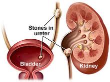 Kidney Stones